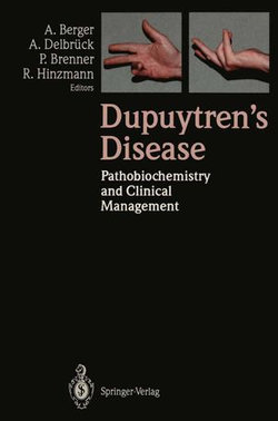 Dupuytren’s Disease