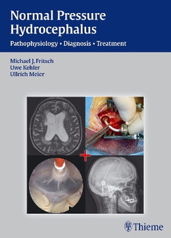 NPH - Normal Pressure Hydrocephalus