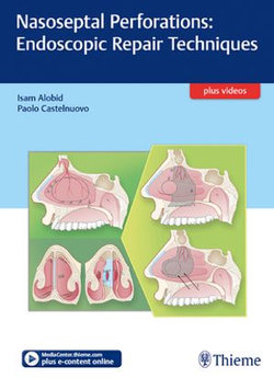 Nasoseptal Perforations: Endoscopic Repair Techniques