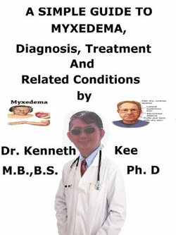 A Simple Guide to Myxedema, Diagnosis, Treatment and Related Conditions