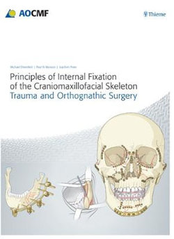 Principles of Internal Fixation of the Craniomaxillofacial Skeleton