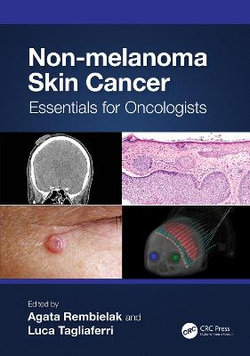 Non-melanoma Skin Cancer