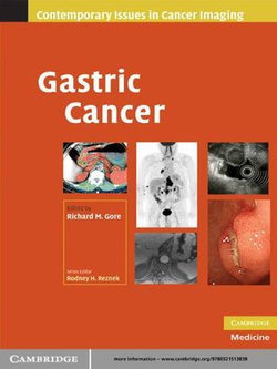 Gastric Cancer