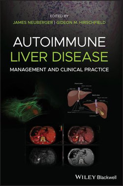 Autoimmune Liver Disease