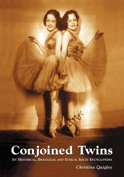 Conjoined Twins