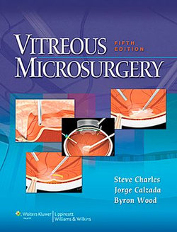 Vitreous Microsurgery