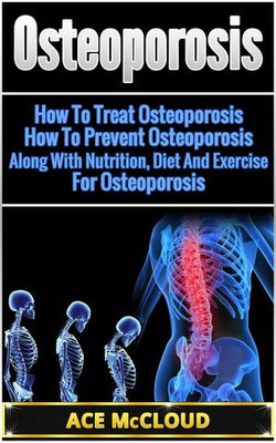 Osteoporosis: How To Treat Osteoporosis: How To Prevent Osteoporosis: Along With Nutrition, Diet And Exercise For Osteoporosis