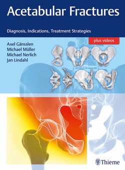 Acetabular Fractures