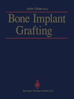 Bone Implant Grafting